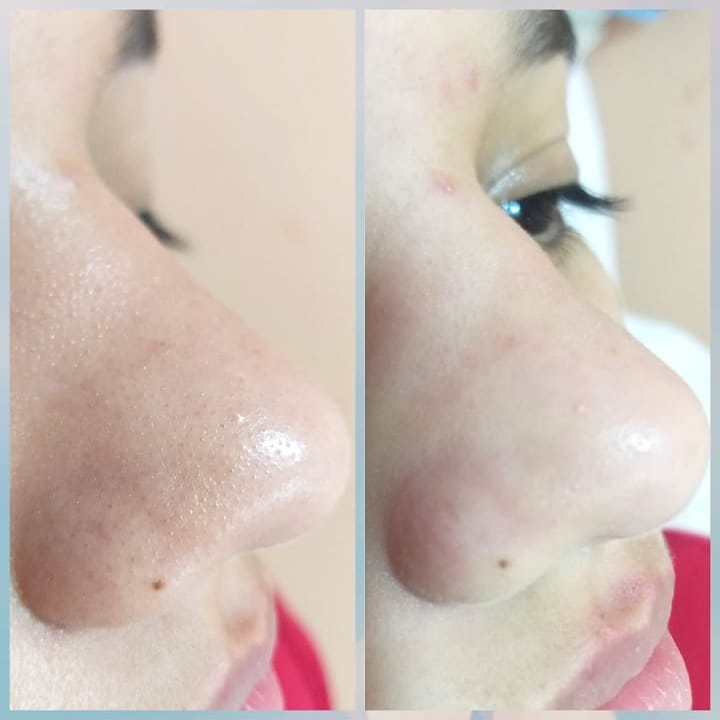 Evolução do tratamento de acne - Foto 5